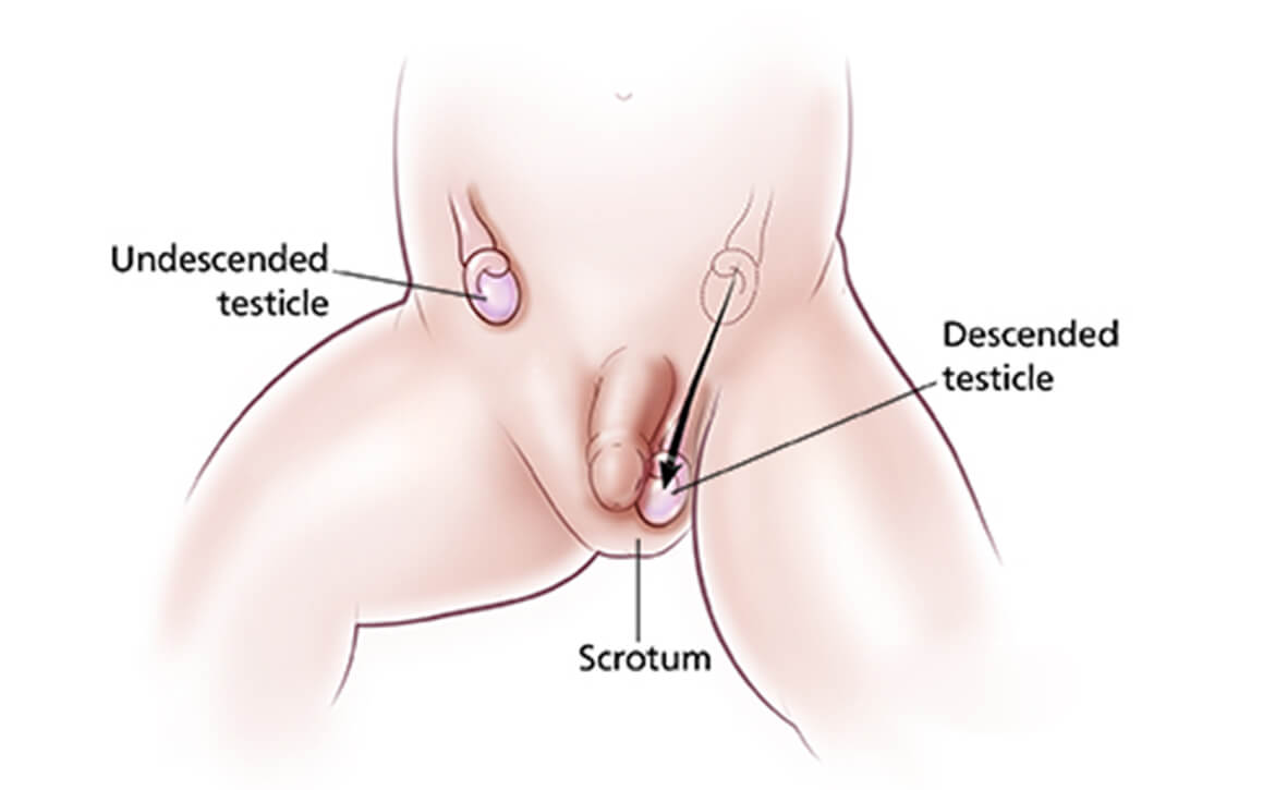 Testis Undescende, chirurgie robotique en Inde, hôpitaux de chirurgie robotique en Inde